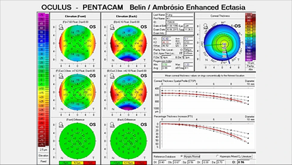 PENTACAM HR 의 각막 형태 분석 리포트(BAD D)