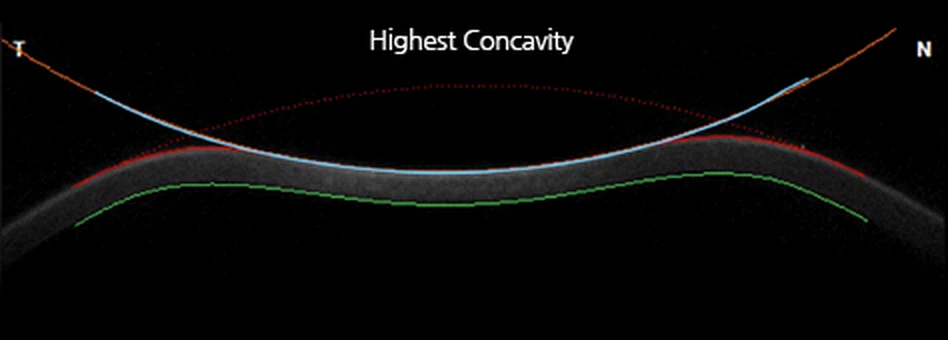 공기압으로 각막이 가장 깊게 함몰된 순간(Highest Concavity)의 각막 단면 실측 화면