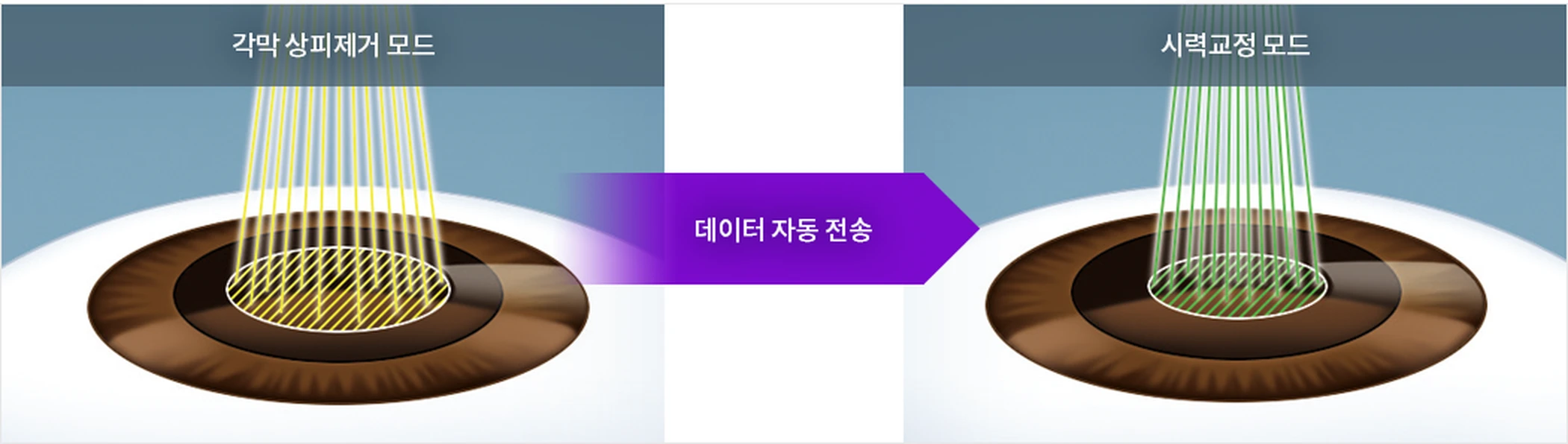 각막 상피제거 모드와 시력교정 모드가 데이터 자동 전송으로 이어지는 개념도