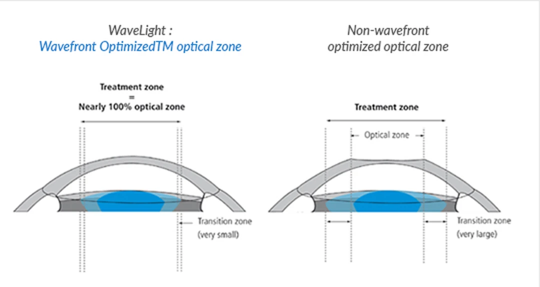 WaveLight Wavefront Optimized 광학부는 치료영역이 광학부와 거의 100% 일치하고 이행부가 매우 작은 반면, 일반 광학부는 치료영역이 넓고 이행부가 매우 크다
